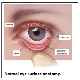 Pinguecula (Yellow Bump on Eyeball): Diagnosis, Causes & Treatment