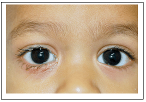 bebeklerde göz sağlığı
