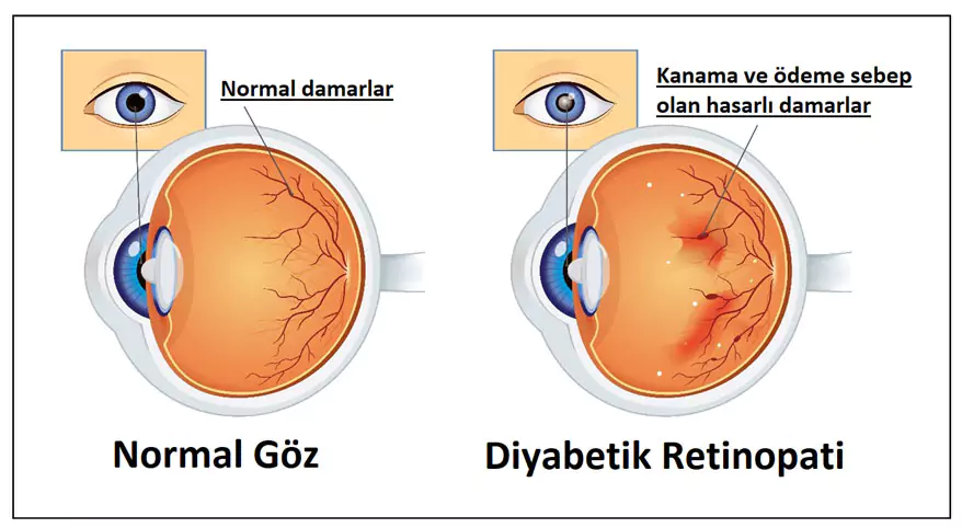 Diyabetik Retinopati