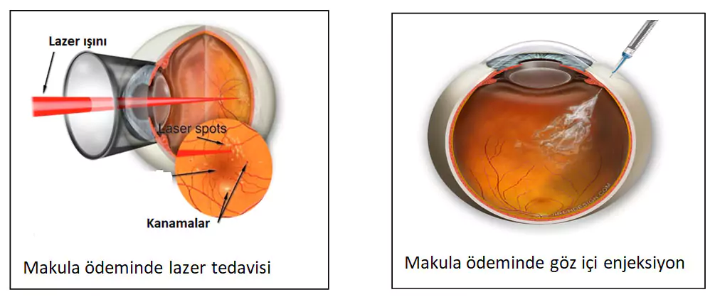 Diyabetik Retinopati tedavisi