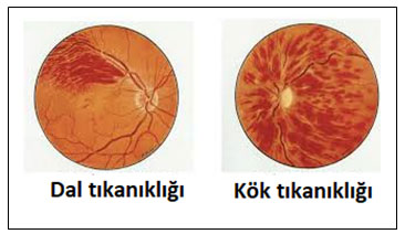Retinal Ven Toplardamar Tikanikligi Prof Dr Gokhan Gulkilik