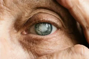 Gözde Katarakt Varsa Ne Olur