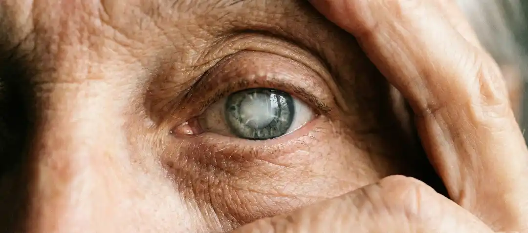 Gözde Katarakt Varsa Ne Olur